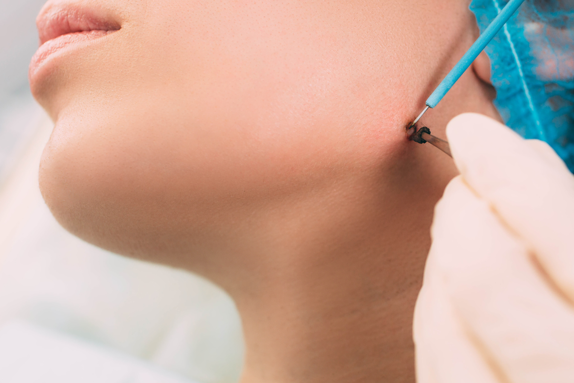 Mole Removal