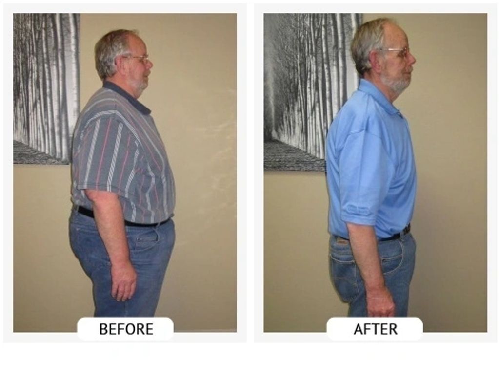 Before and After- Bill lost 160 lbs and 72.5 inches.
