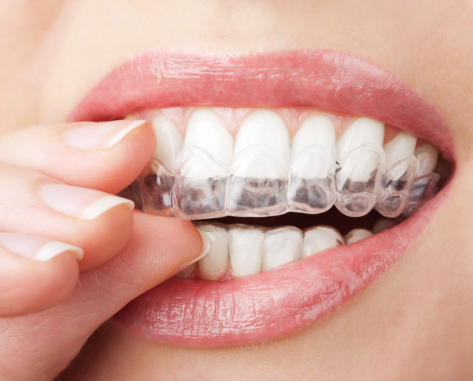 ortodonzia invisibile Catania Dentista Sgroi