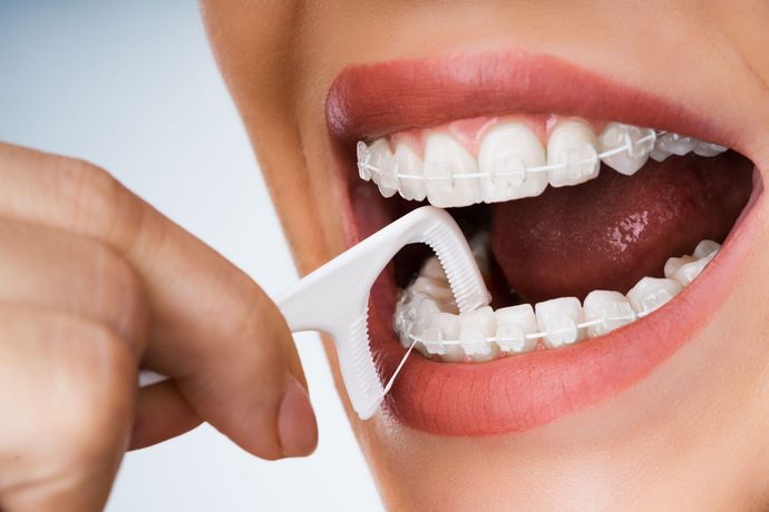 sbiancamento dentale
