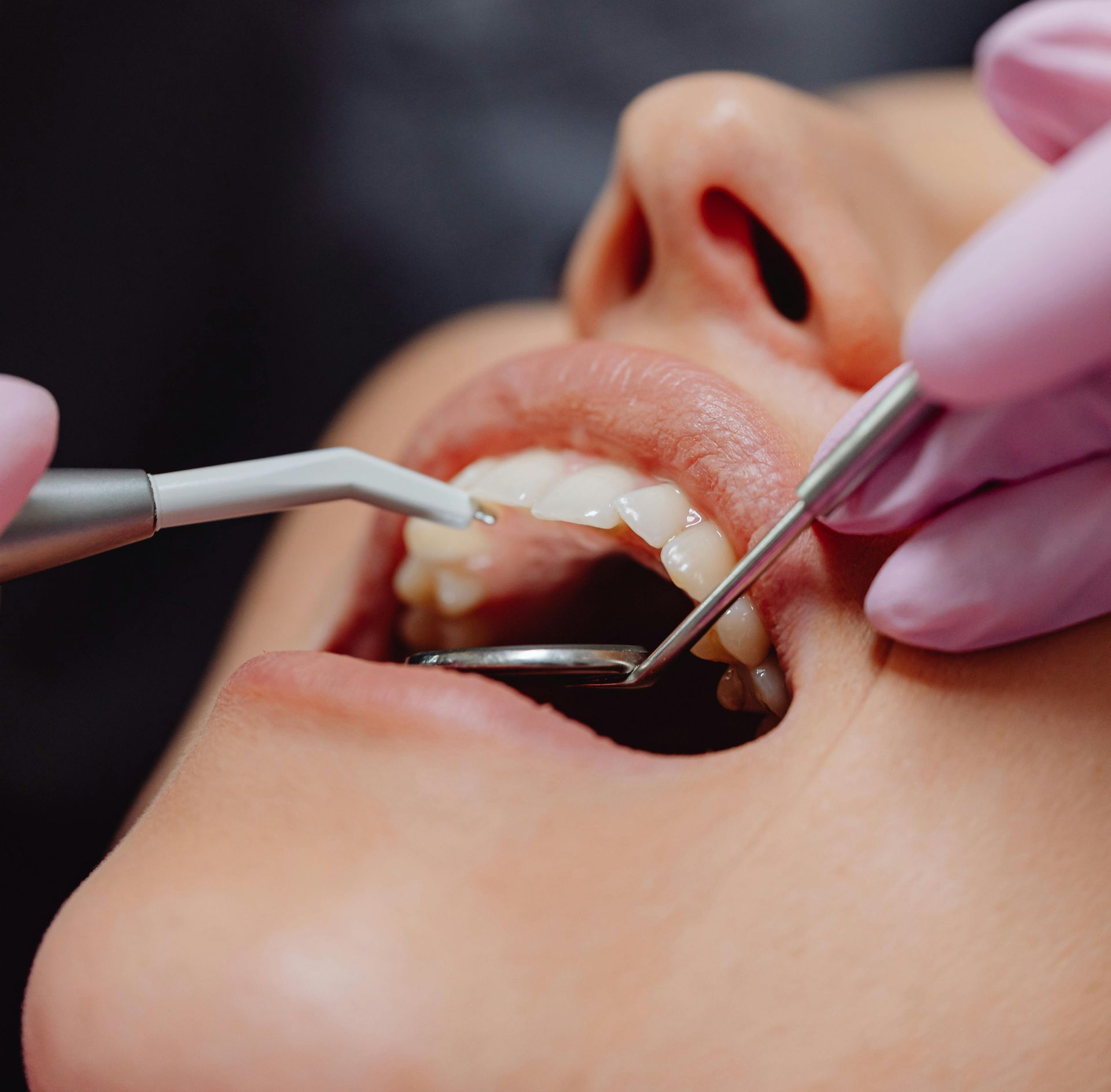 A Person Receiving A Teeth Clean  Service— BB Dental Cairns Dentists Dental In Earlville, QLD