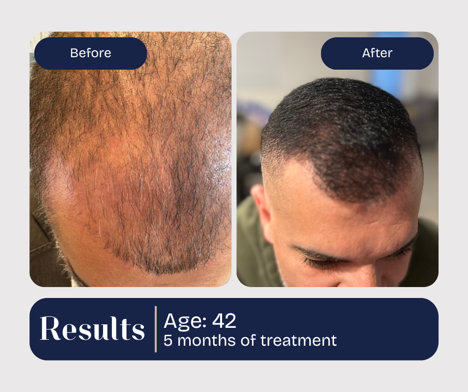 Before and after hair transplant results for a 42-year-old, showing hair growth after 5 months of treatment.