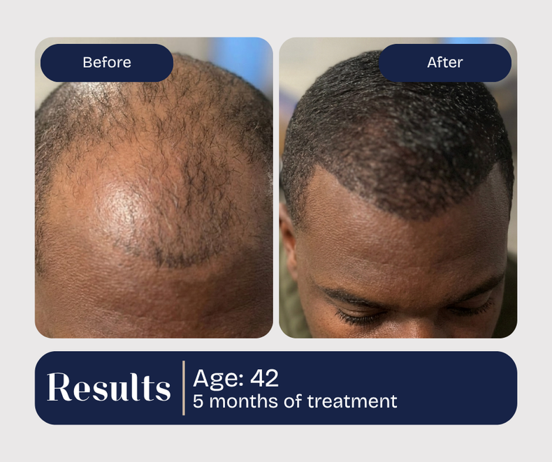 Before and after hair transplant results. A 42-year-old shows hair growth 5 months post-treatment.