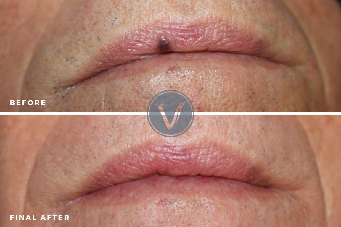 A before and after photo of a man 's lips.
