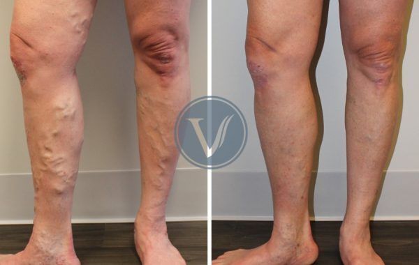 A before and after photo of a person 's legs with varicose veins.