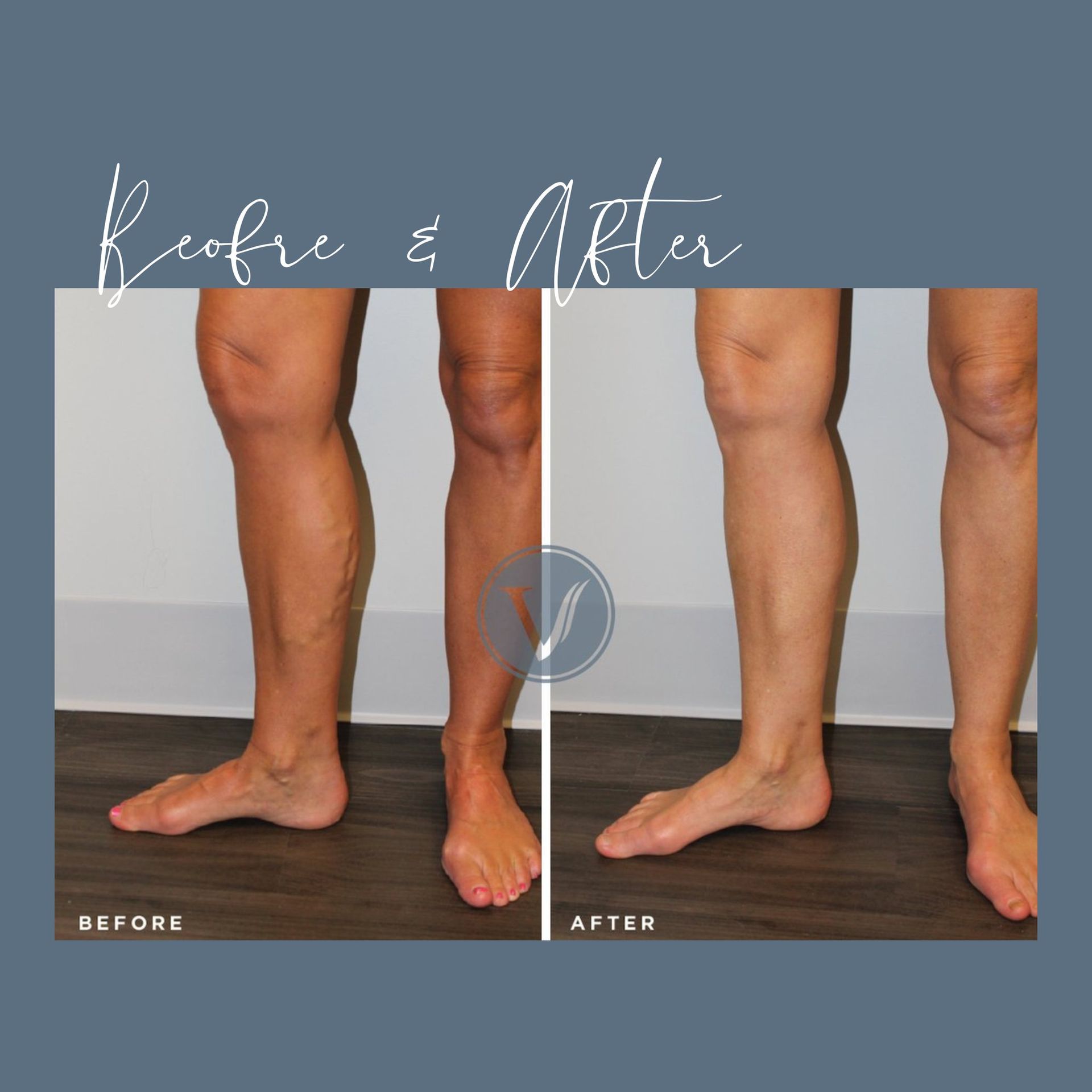 A before and after photo of a person 's legs.