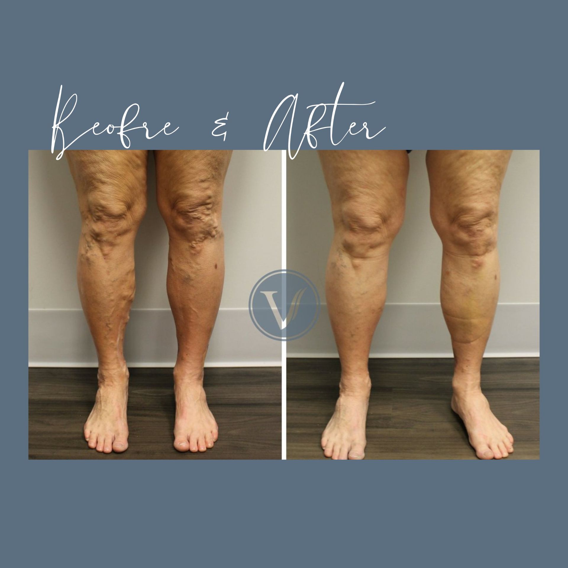A before and after photo of a person 's legs with varicose veins.