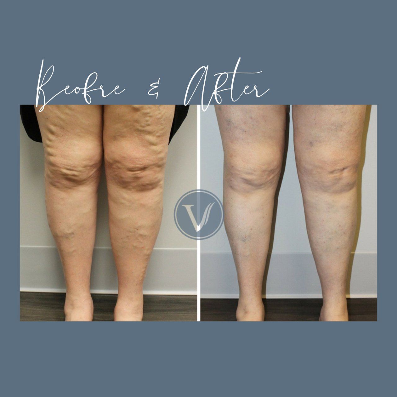 A picture of a woman 's legs before and after surgery