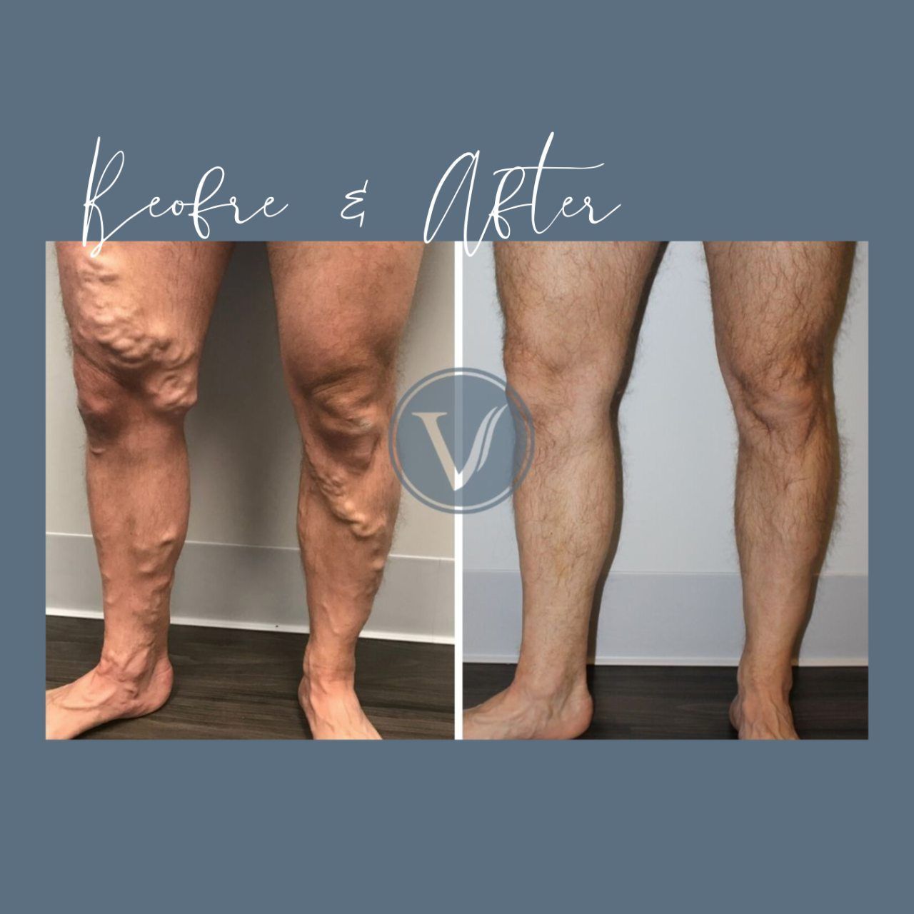 A before and after photo of a man 's legs with varicose veins