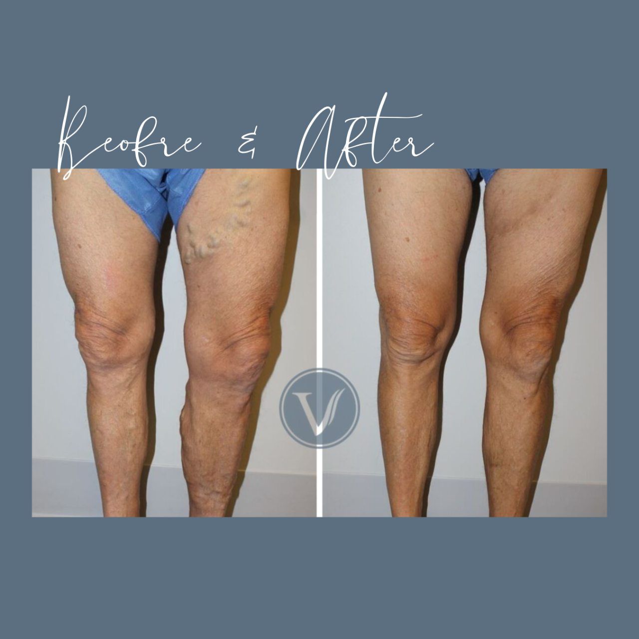 A before and after photo of a person 's legs