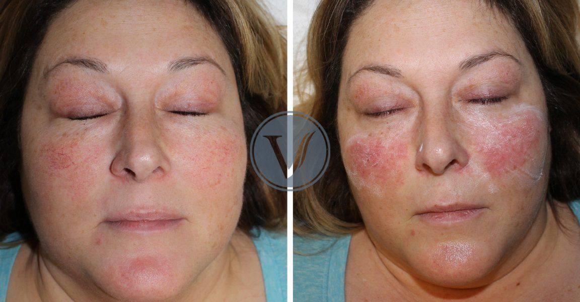 A before and after photo of a woman 's face with red spots.