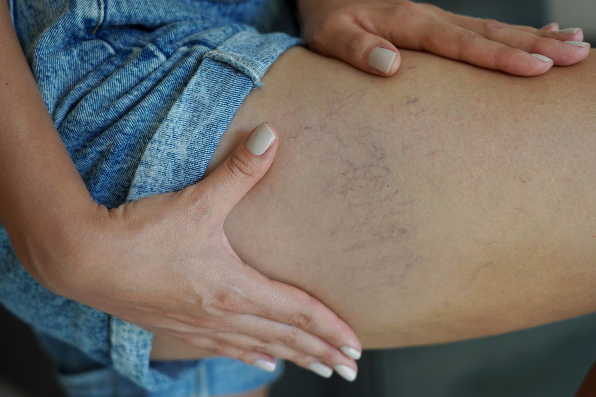 A woman is holding her leg with varicose veins on it.