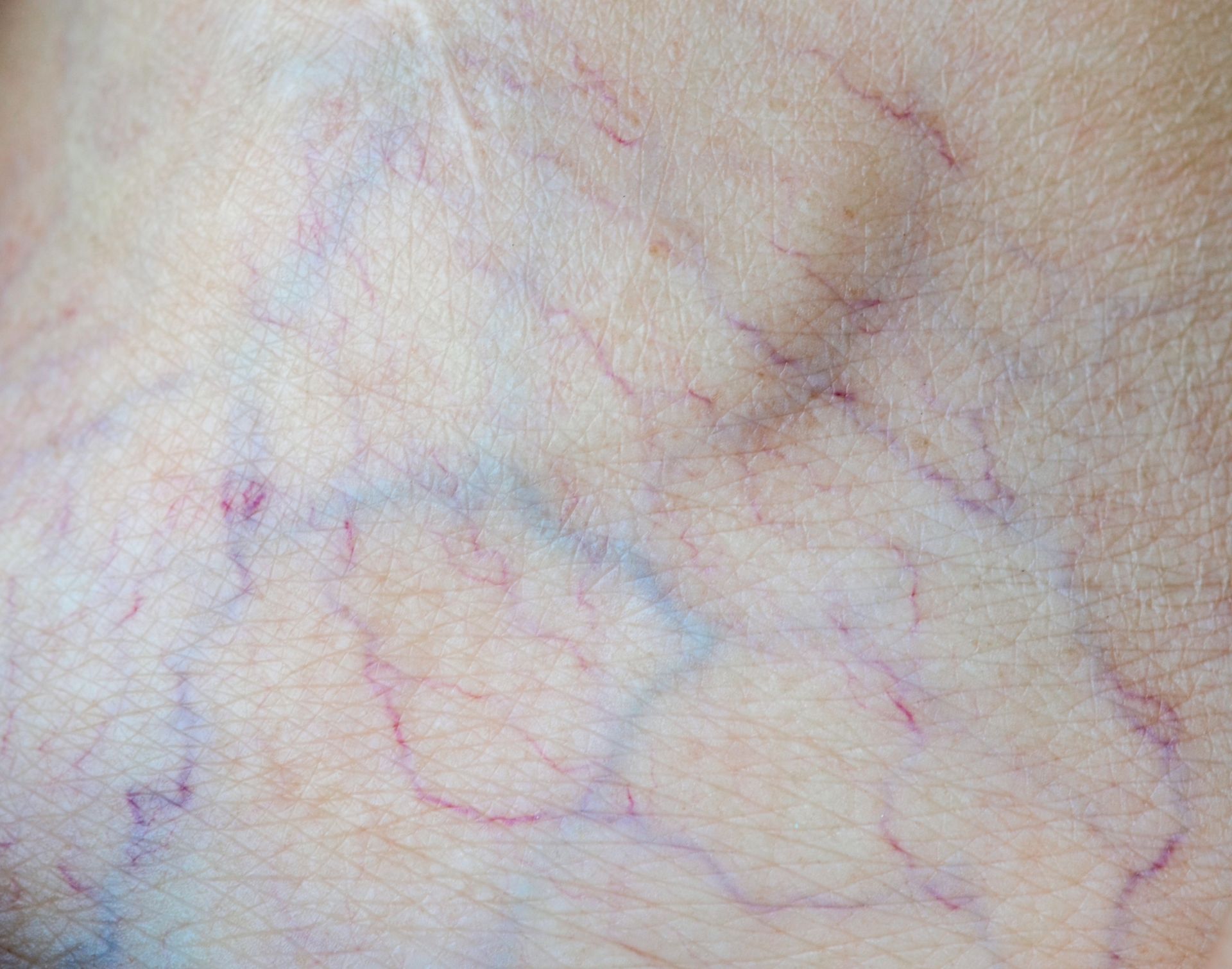 A close up of a person 's leg with varicose veins.