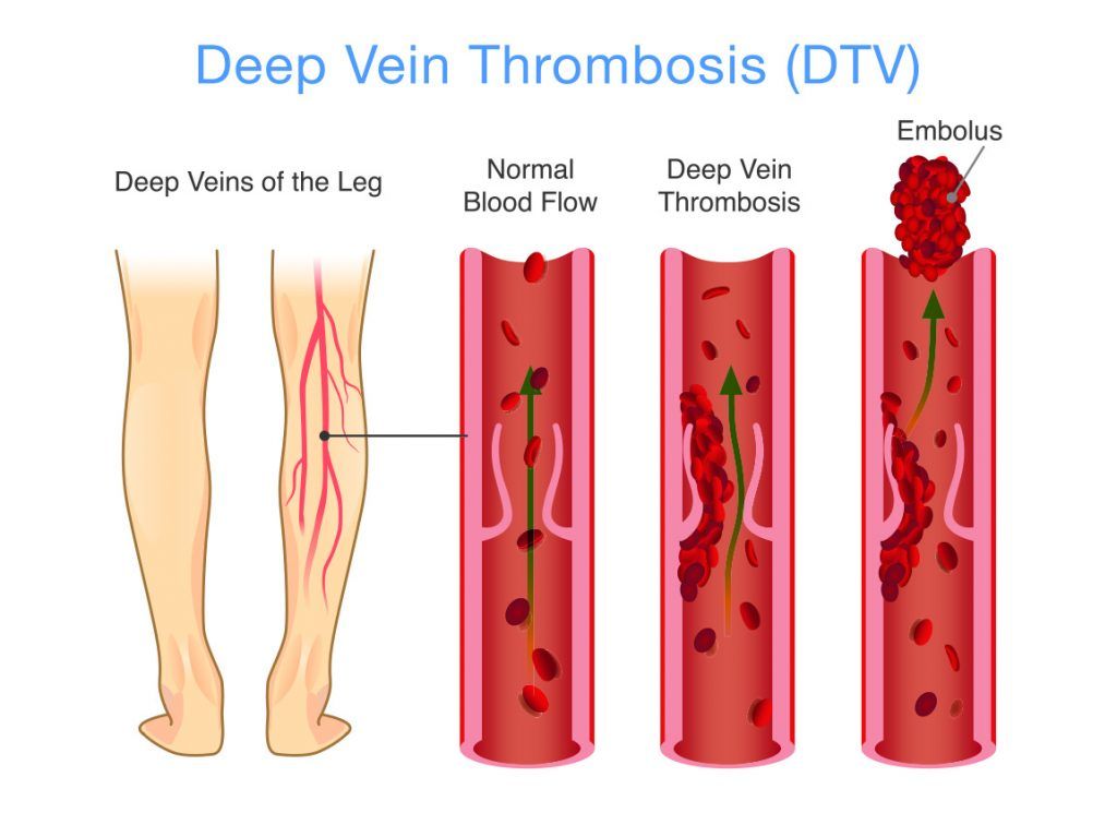 A diagram of deep vein thrombosis ( dtv ) on a white background