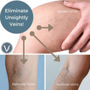 A woman 's leg with spider veins and varicose veins