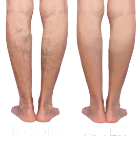 A before and after picture of a person 's legs with varicose veins