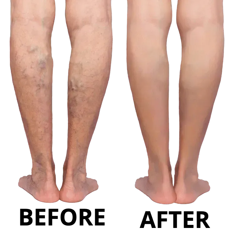 A before and after photo of a person 's legs