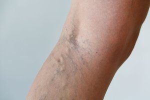 A close up of a person 's leg with varicose veins.