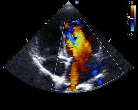 dettaglio color-doppler