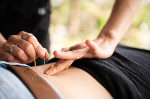 Hands placing thin needles into a person’s lower back during acupuncture treatment