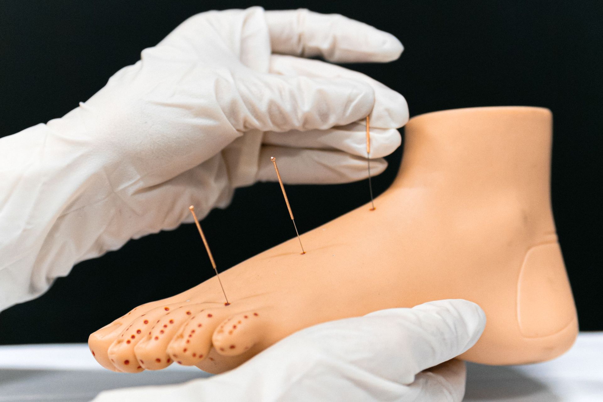 Gloved hands using acupuncture needles on a beige foot model