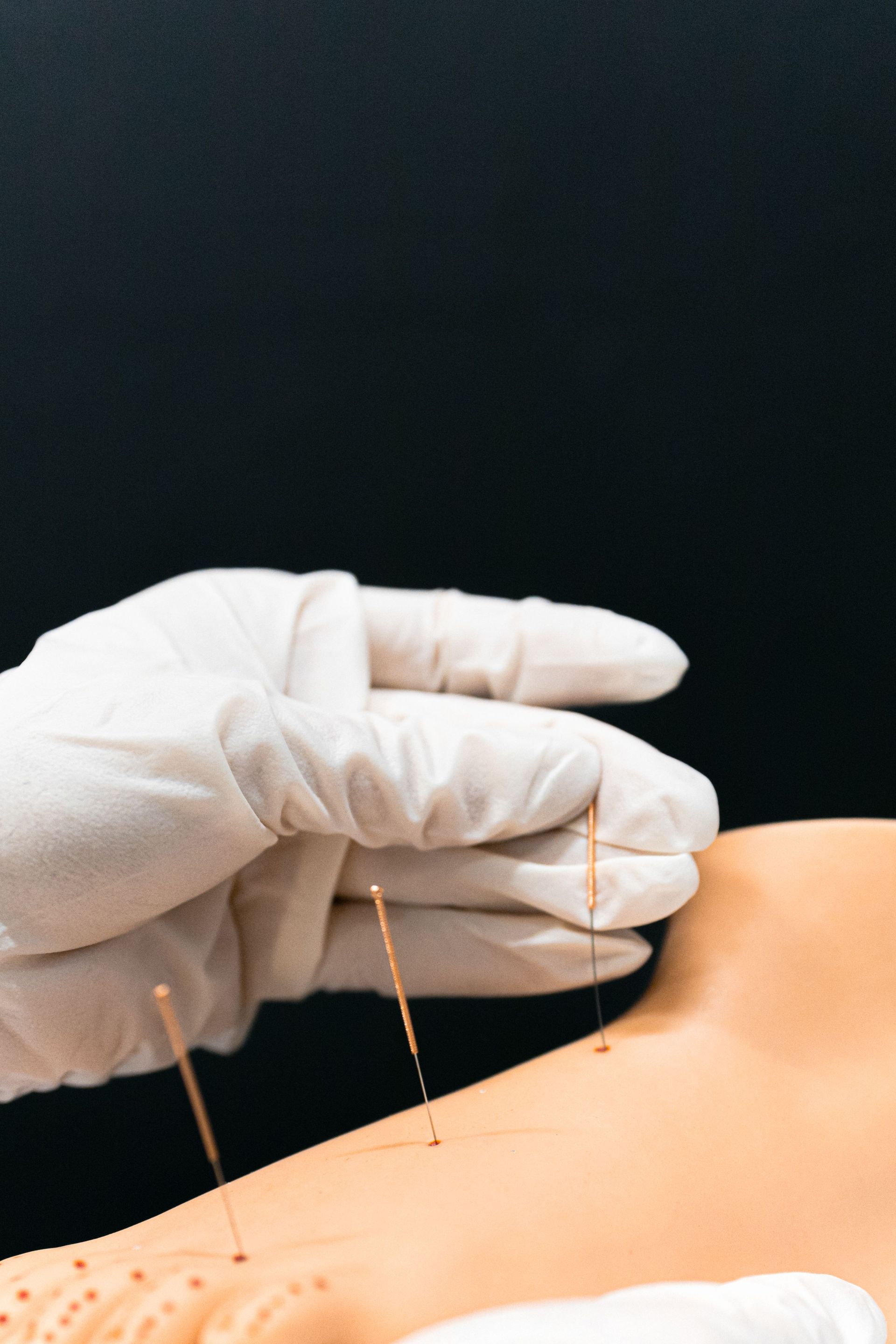 Gloved hand inserting acupuncture needles into a person’s back against a dark background