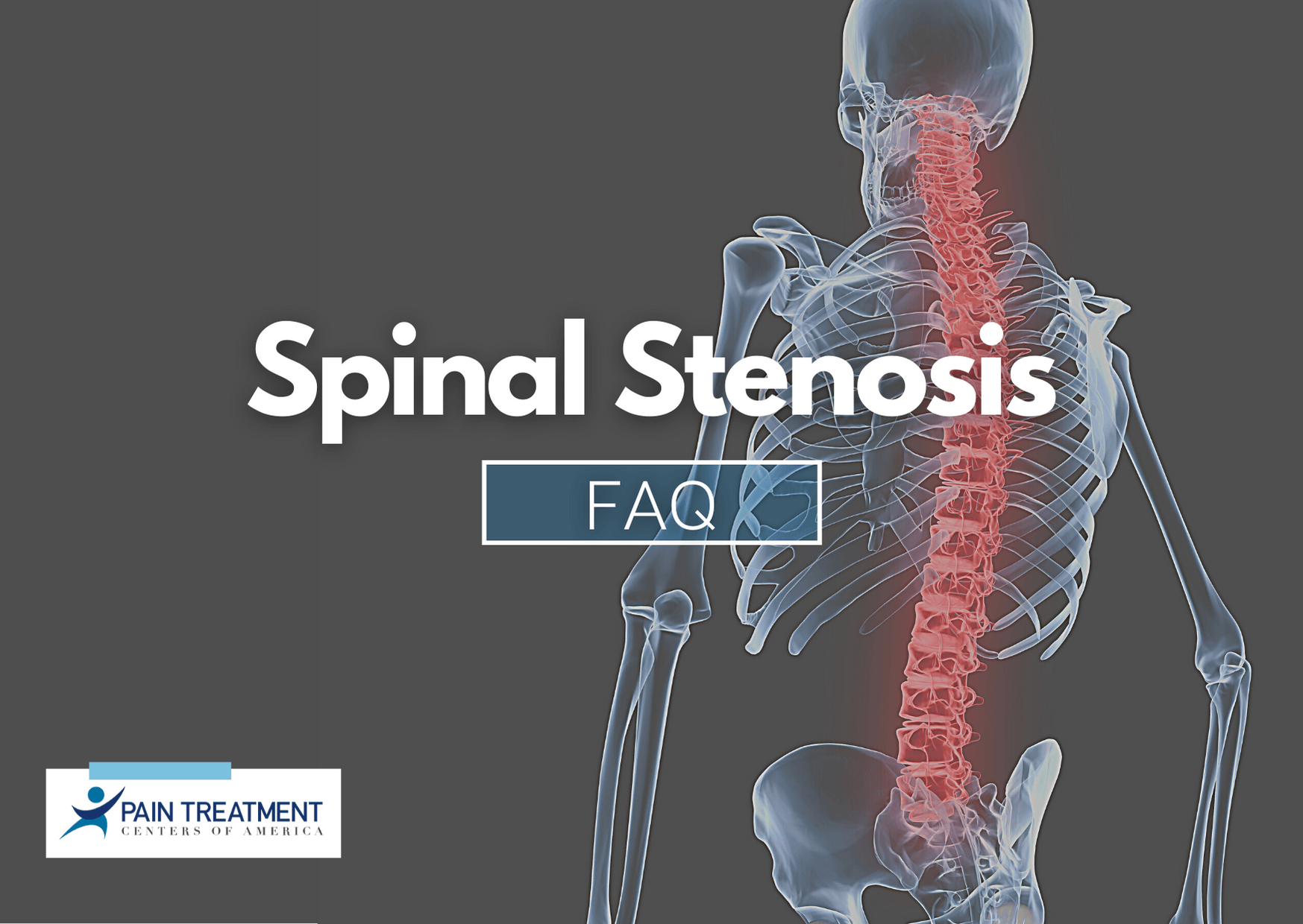 A skeleton with the words spinal stenosis faq on it