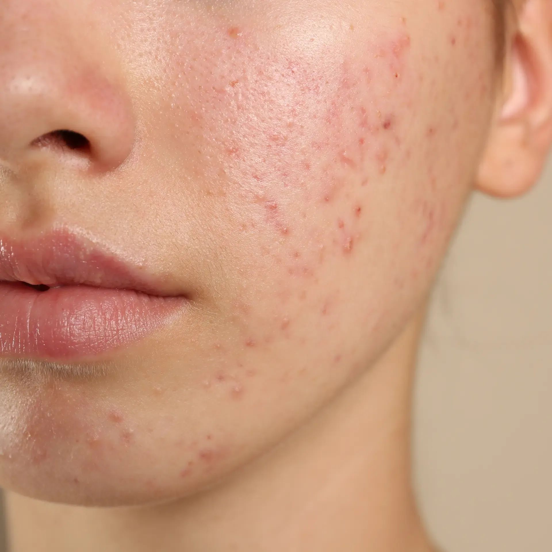 Close-up of a face showing skin with redness, inflammation, and multiple small acne breakouts on the cheek and chin area.