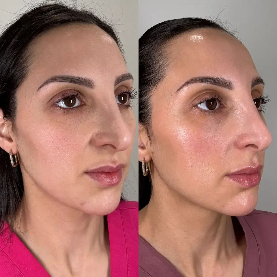 before and after image showing skin before using lumenvy skincare products