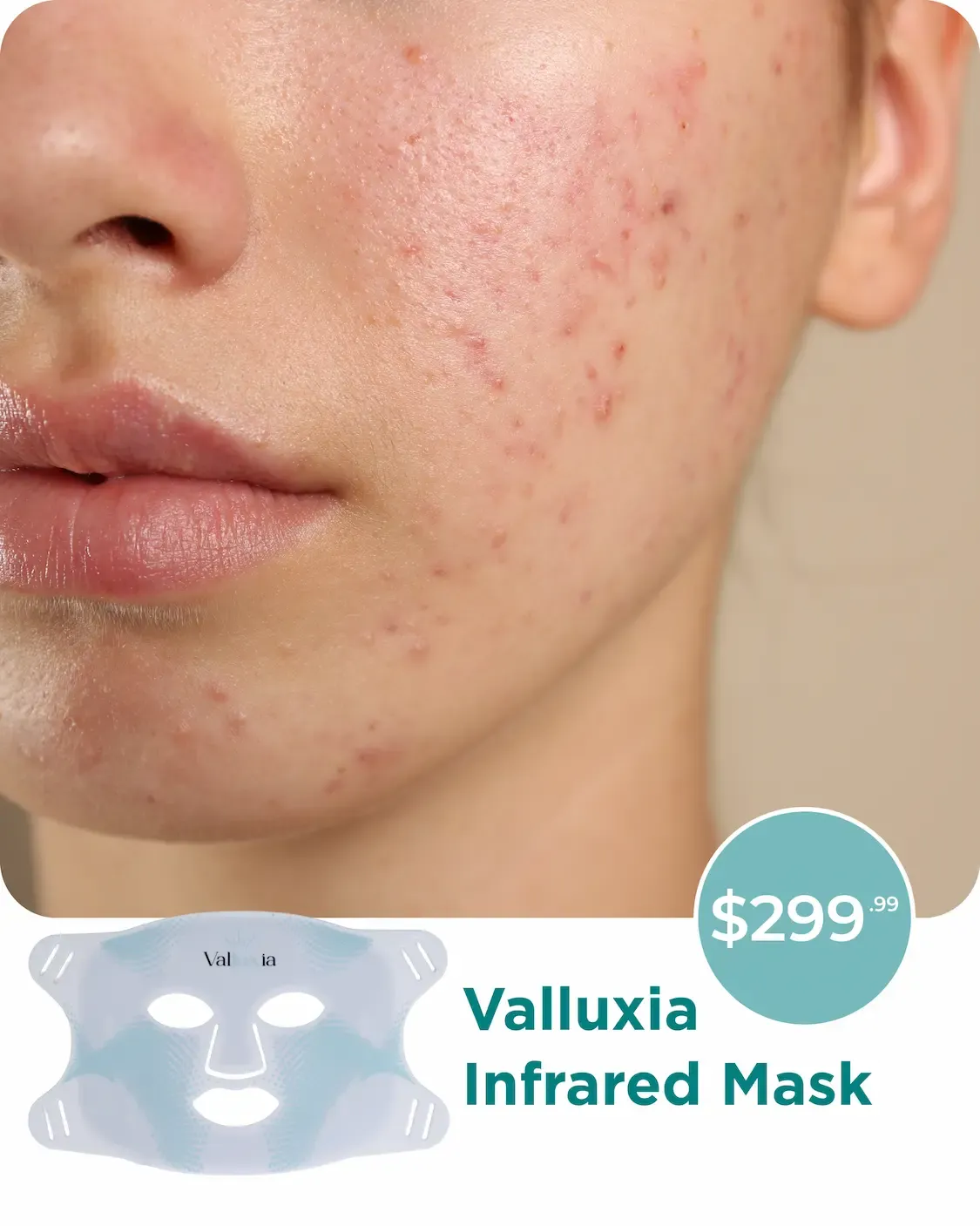 Close-up of a face showing skin with visible acne and redness on the cheek and chin area.