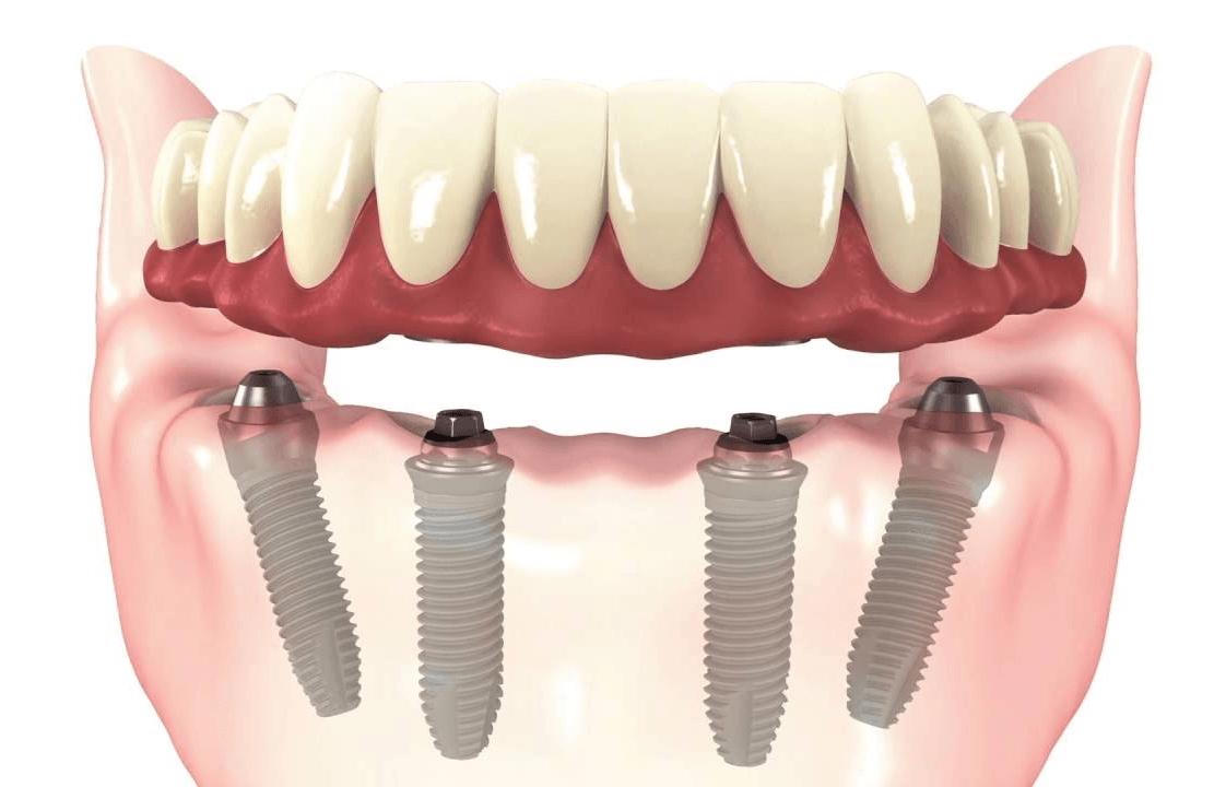 All-on-4 / All-on-X Implants