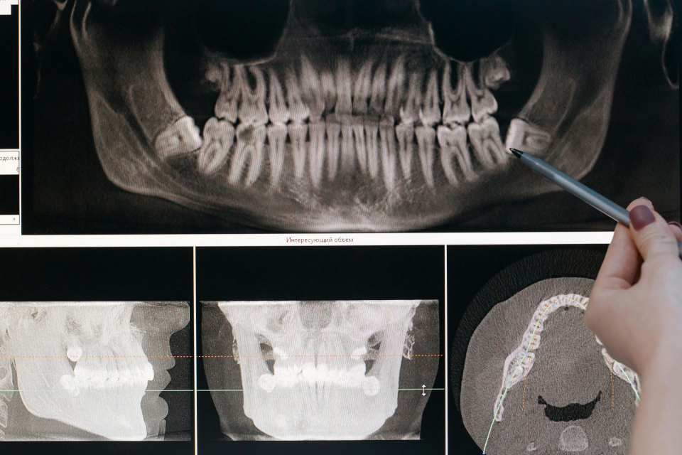 Wisdom Teeth Removal