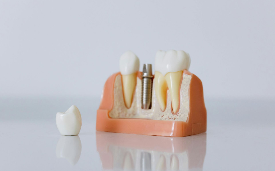 Dental Implants (Single & Full-Arch)