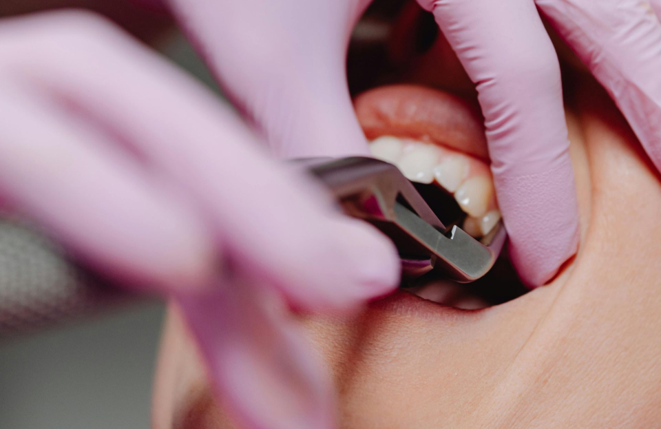 Tooth Extractions