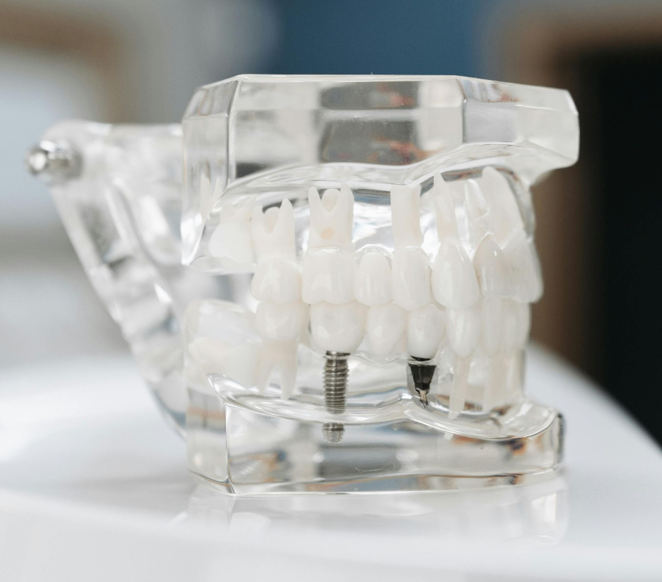 Bone Grafting