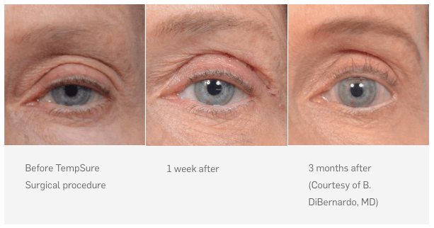 Tempsure Surgical