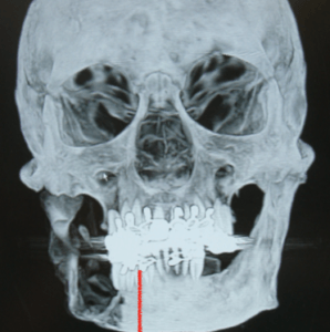 x-ray