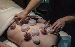 Cupping