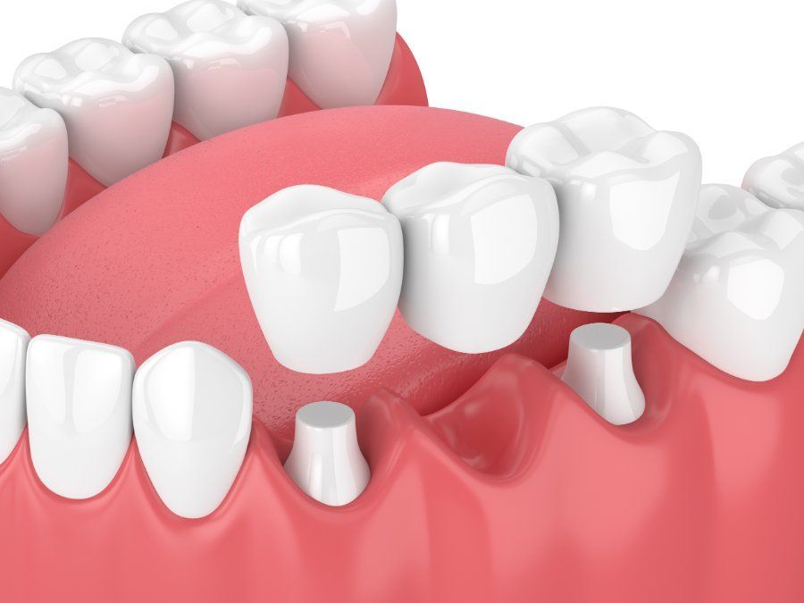 Dental bridge with three artificial teeth supported by two posts in a pink gum.