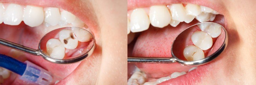 Dentist using a mirror to inspect teeth for cavities, showing fillings on a molar.