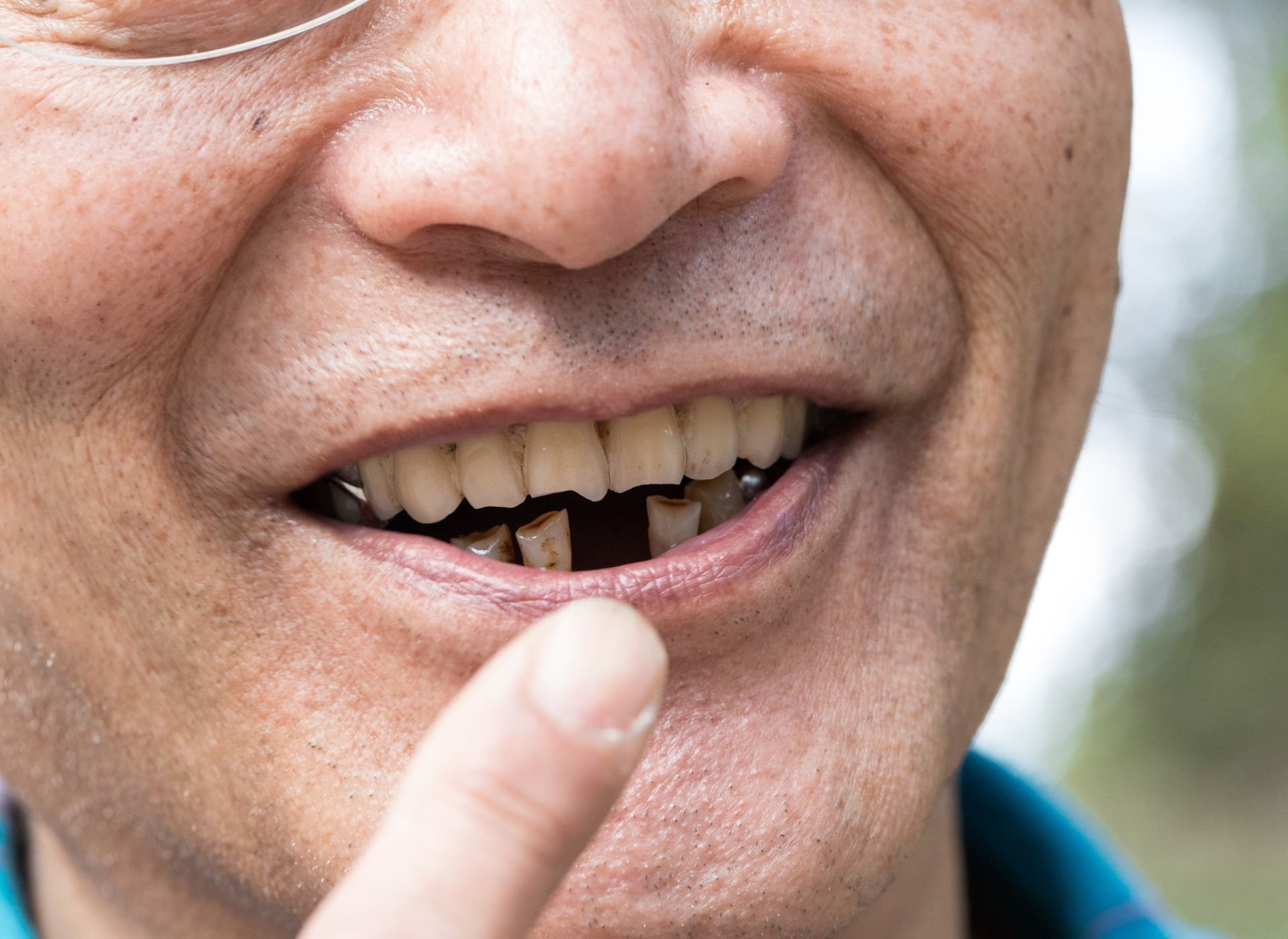 Close-up of a person’s mouth showing upper teeth with a bridge and lower teeth with gaps and discoloration.