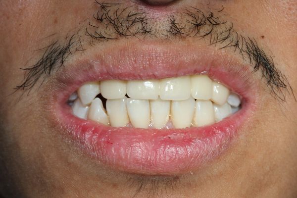 Two Implant After