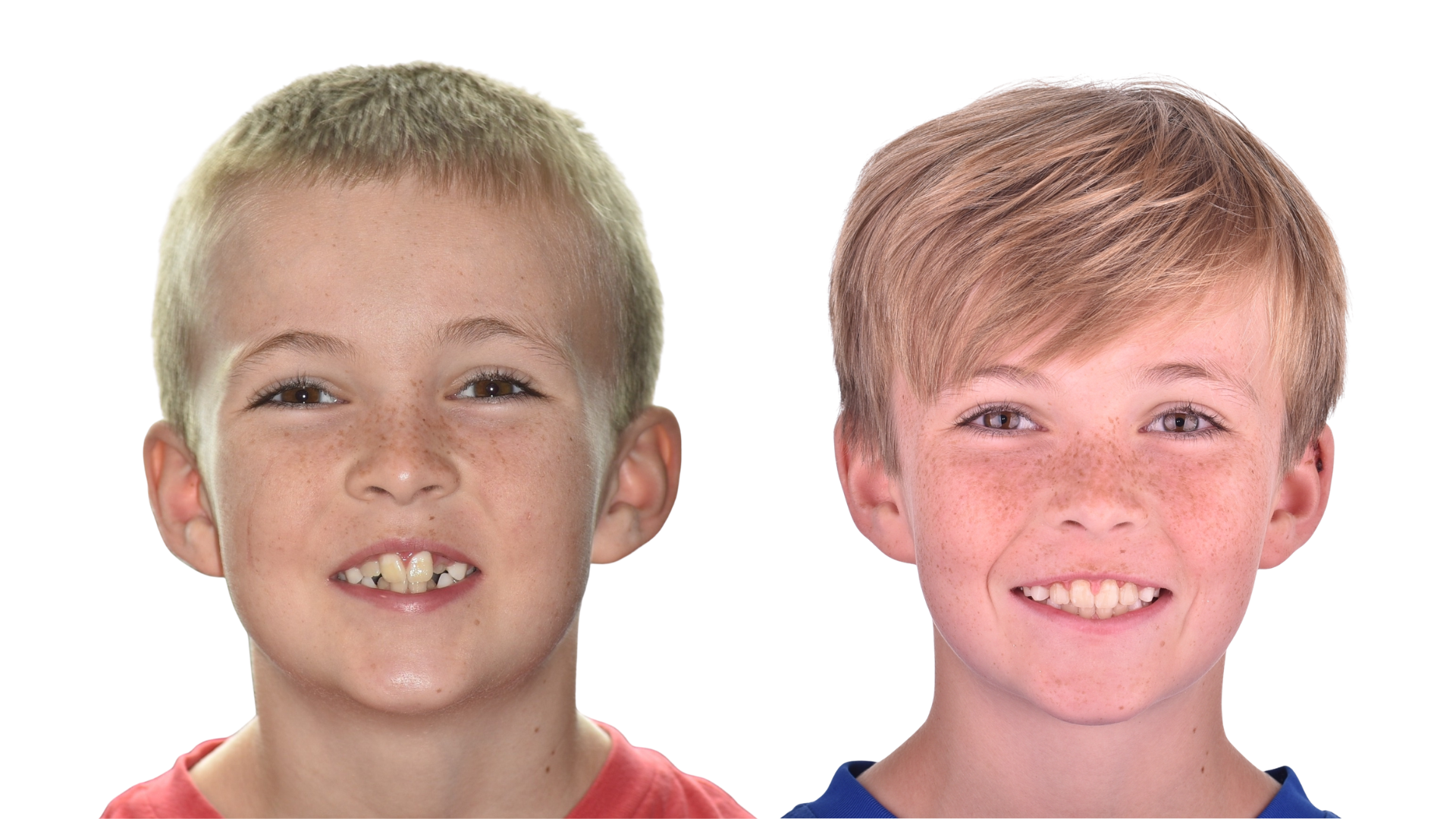 Before and after photos of Phase I palatal expansion widening a child's upper arch at Excelsior Orthodontics in Purcellville, VA