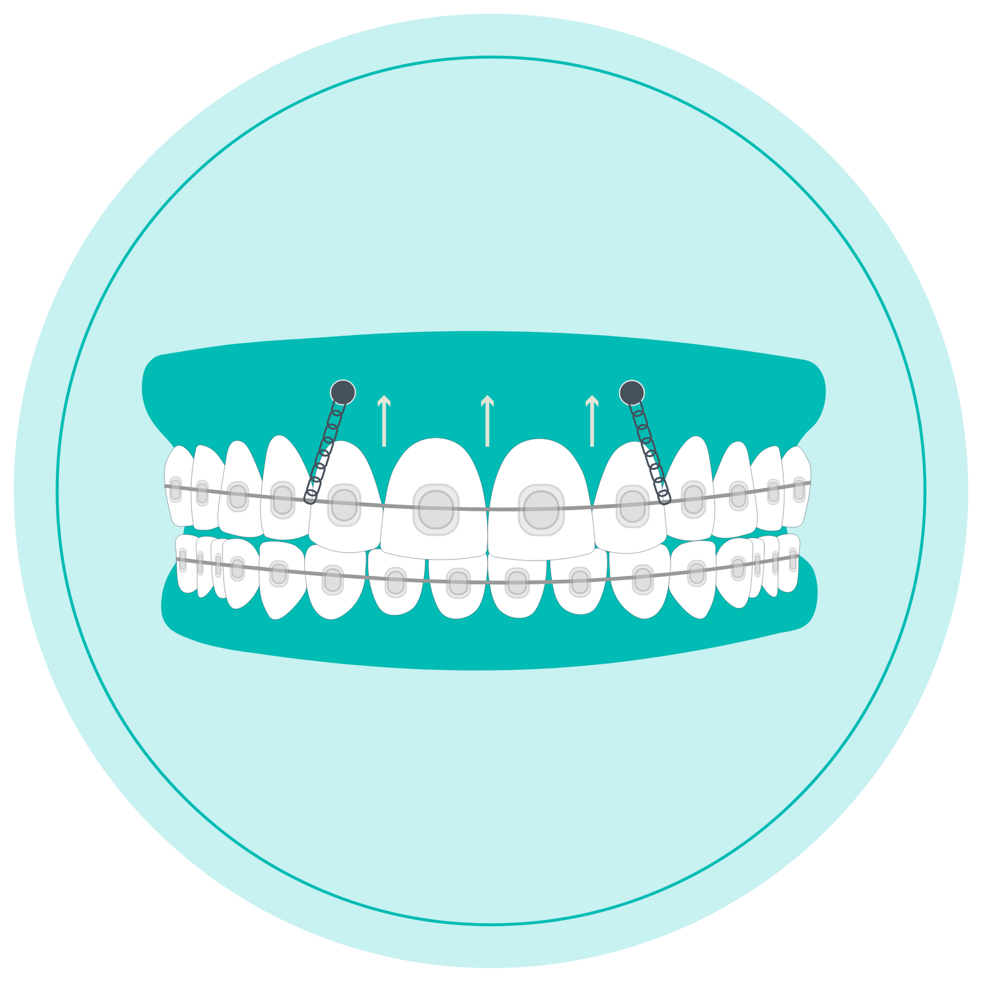 Teal orthodontic braces on white teeth with arrows indicating upward adjustment inside a circle