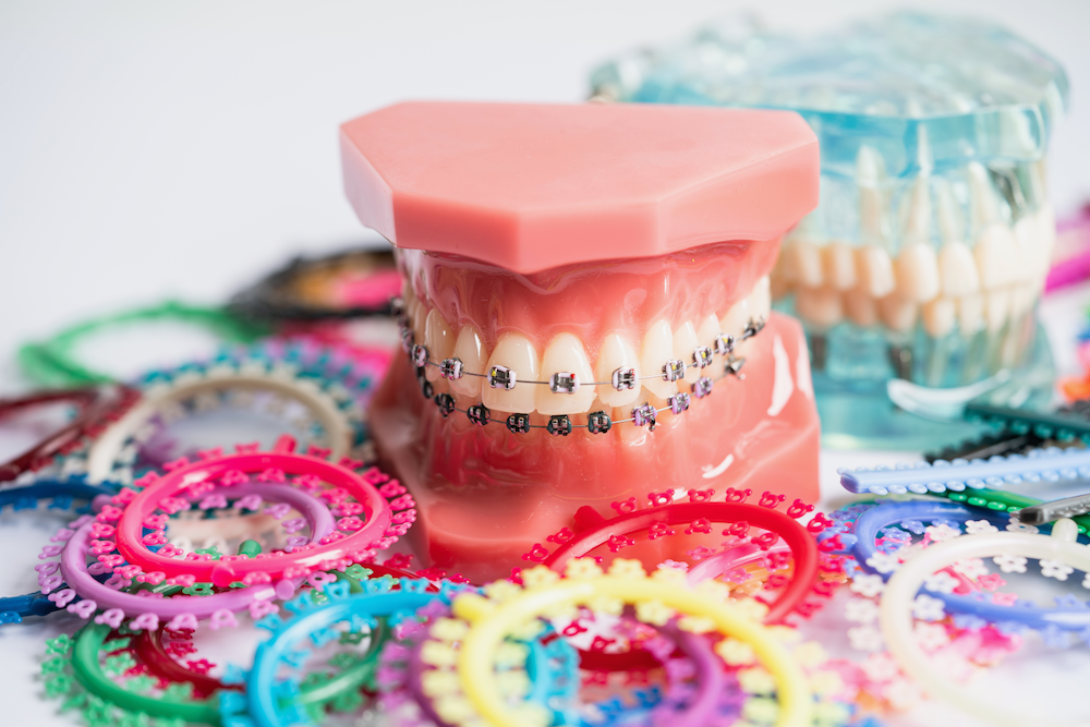 A model of a person 's teeth with braces and rubber bands.