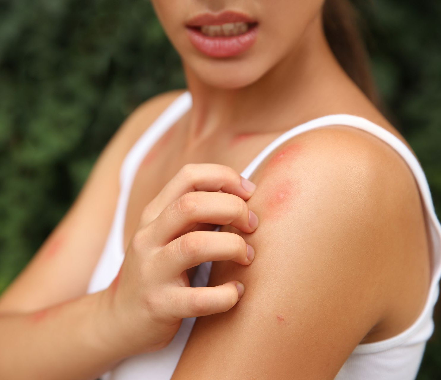 Close-up of a person scratching a red, irritated shoulder outdoors