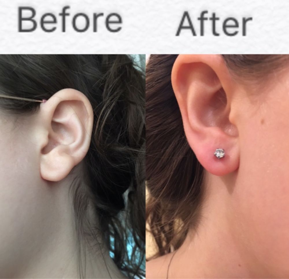 Before-and-after close-up of an ear, showing a new earring piercing with a small gem stud.