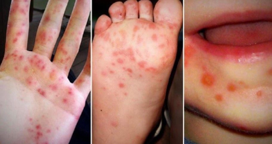 three different rashes
