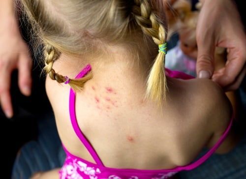 Young girl with plaits and insect bites on her upper back