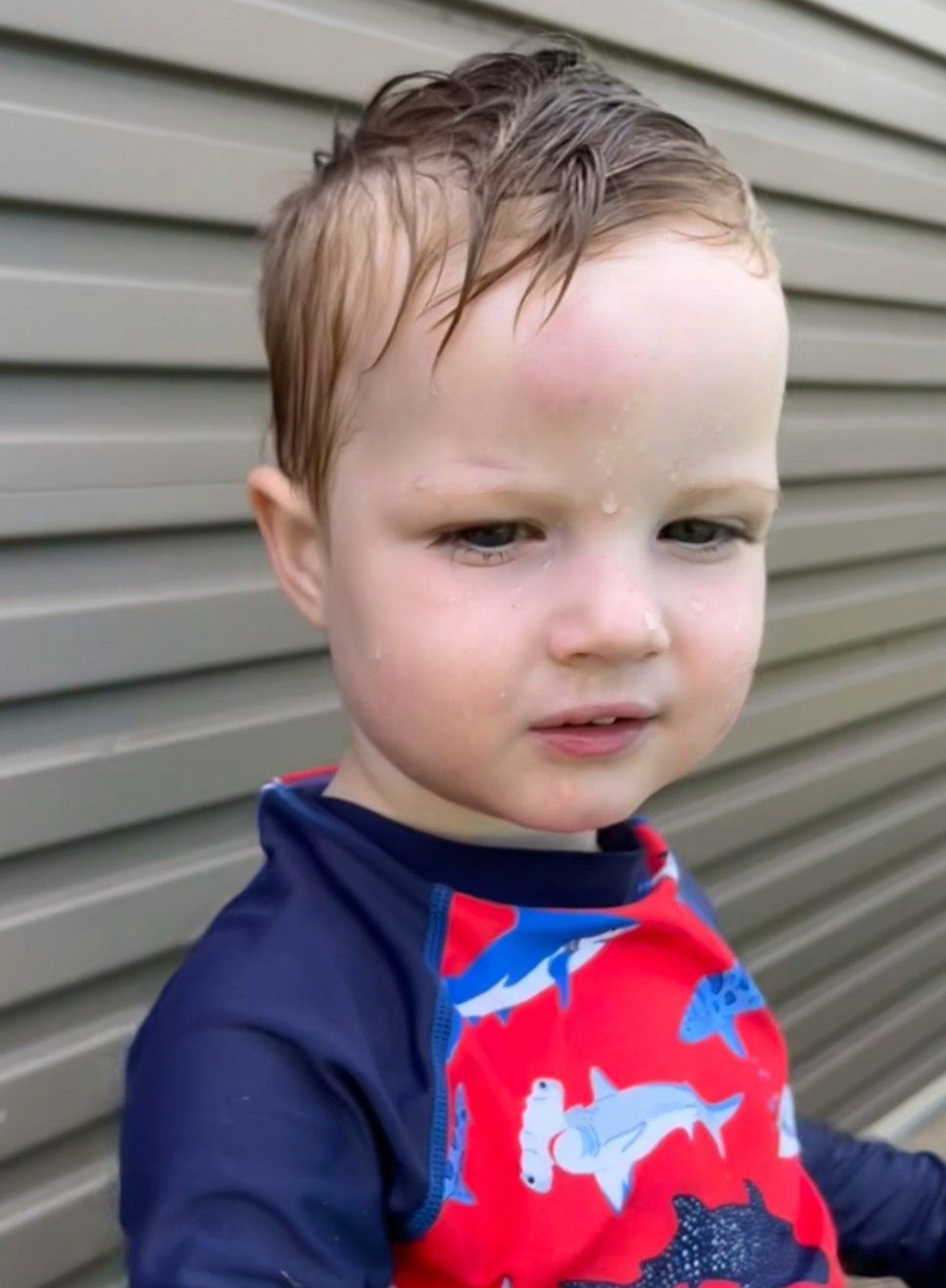 small child with large red mark on his forehead